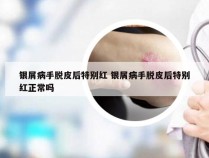 银屑病手脱皮后特别红 银屑病手脱皮后特别红正常吗