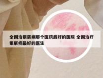 全国治银屑病那个医院最好的医院 全国治疗银屑病最好的医生
