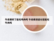 牛皮癣好了能吃鸡肉吗 牛皮癣消退以后能吃牛肉吗