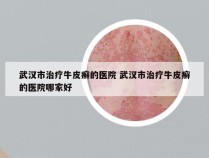 武汉市治疗牛皮癣的医院 武汉市治疗牛皮癣的医院哪家好