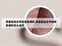 真菌感染会导致银屑病吗 真菌感染会导致银屑病吗怎么治疗