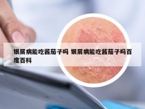 银屑病能吃酱茄子吗 银屑病能吃酱茄子吗百度百科