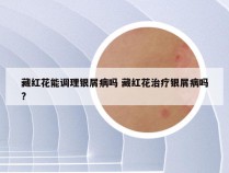 藏红花能调理银屑病吗 藏红花治疗银屑病吗?