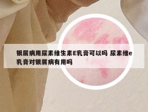 银屑病用尿素维生素E乳膏可以吗 尿素维e乳膏对银屑病有用吗