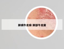 脚病牛皮癣 脚部牛皮廨