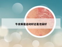 牛皮癣是运动好还是泡澡好