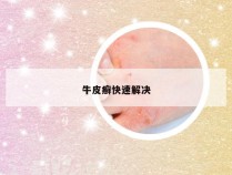 牛皮癣快速解决