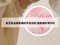 是否有治银屑病的中药洗剂 银屑病外用中药