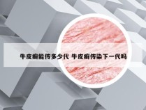牛皮癣能传多少代 牛皮癣传染下一代吗