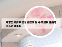 寻常型银屑病禁忌哪些东西 寻常型银屑病吃什么药效果好