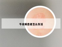 牛皮癣患者怎么生活