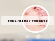 牛皮癣头上身上都长了 牛皮肤癣长头上