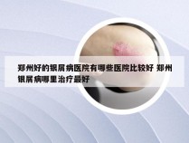 郑州好的银屑病医院有哪些医院比较好 郑州银屑病哪里治疗最好
