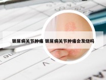 银屑病关节肿痛 银屑病关节肿痛会发烧吗