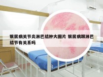 银屑病关节炎淋巴结肿大图片 银屑病跟淋巴结节有关系吗