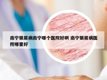 南宁银屑病南宁哪个医院好啊 南宁银屑病医院哪里好