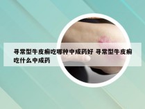 寻常型牛皮癣吃哪种中成药好 寻常型牛皮癣吃什么中成药