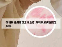 深圳银屑病应该怎样治疗 深圳银屑病医院怎么样