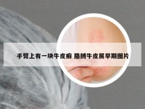 手臂上有一块牛皮癣 胳膊牛皮屑早期图片