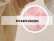 有牛皮癣可以做试管吗