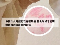中国什么时候能攻克银屑病 什么时候才能研制出根治银屑病的方法