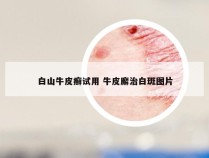 白山牛皮癣试用 牛皮廨治白斑图片