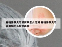扁桃体发炎与银屑病怎么检测 扁桃体发炎与银屑病怎么检测出来
