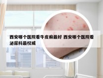 西安哪个医院看牛皮癣最好 西安哪个医院看泌尿科最权威