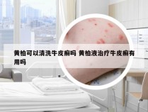 黄柏可以清洗牛皮癣吗 黄柏液治疗牛皮癣有用吗