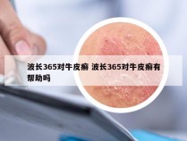 波长365对牛皮癣 波长365对牛皮癣有帮助吗
