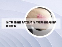 治疗银屑病什么软膏好 治疗银屑病最好的药膏是什么