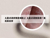 儿童点滴状银屑病脸上 儿童点滴银屑病一直出新皮疹