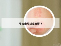 牛皮癣可以吃青萝卜