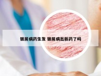 银屑病药生发 银屑病出新药了吗