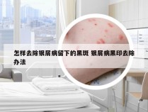 怎样去除银屑病留下的黑斑 银屑病黑印去除办法