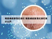 银屑病皮肤发红腐烂 银屑病皮肤发红腐烂用什么药
