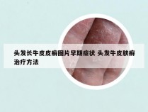 头发长牛皮皮癣图片早期症状 头发牛皮肤癣治疗方法