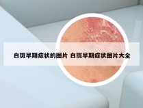 白斑早期症状的图片 白斑早期症状图片大全