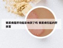银屑病是肝功能影响到了吗 银屑病引起的肝损害