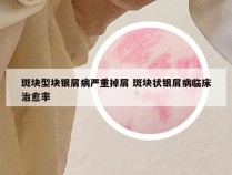 斑块型块银屑病严重掉屑 斑块状银屑病临床治愈率