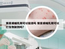 银屑病哺乳期可以输液吗 银屑病哺乳期可以打生物制剂吗?