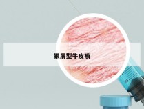 银屑型牛皮癣