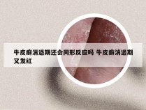 牛皮癣消退期还会同形反应吗 牛皮癣消退期又发红