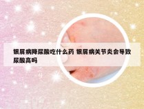 银屑病降尿酸吃什么药 银屑病关节炎会导致尿酸高吗