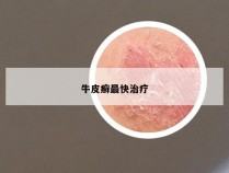 牛皮癣最快治疗