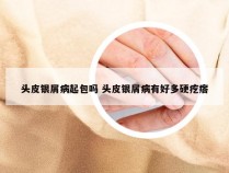 头皮银屑病起包吗 头皮银屑病有好多硬疙瘩