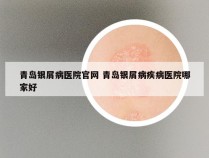 青岛银屑病医院官网 青岛银屑病疾病医院哪家好