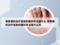 银屑病的治疗目前的最好办法是什么 银屑病的治疗目前的最好办法是什么药