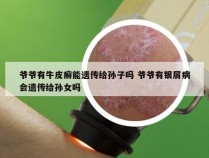 爷爷有牛皮癣能遗传给孙子吗 爷爷有银屑病会遗传给孙女吗