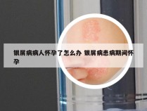 银屑病病人怀孕了怎么办 银屑病患病期间怀孕
